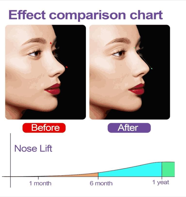 Nose Up Clip (Correction For Shaping Nose Tool)